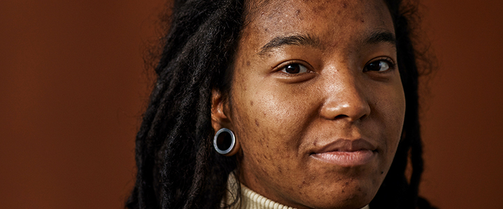 Mulher negra com manchas na pele.