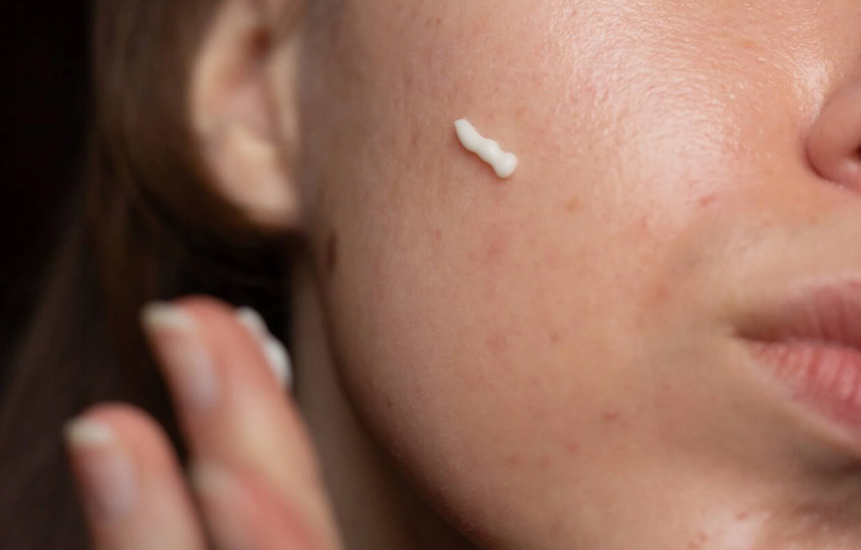 Aplicação de creme ou ácido numa pele facial de uma mulher.