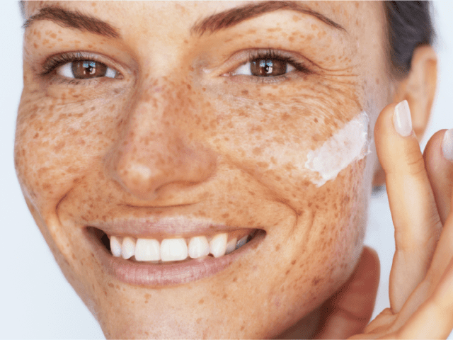 Mulher com sardas utilizando creme clareador na pele.